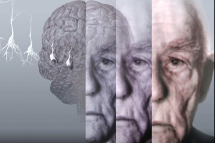 آلزایمر چه علائمی دارد؟