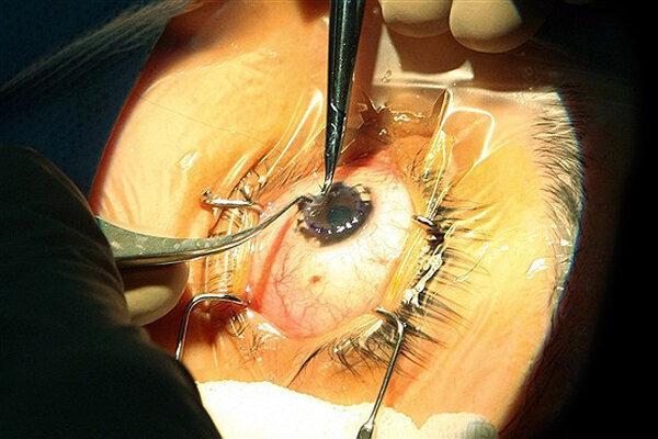 انجام اولین عمل جراحی پیوند قرنیه در سیرجان