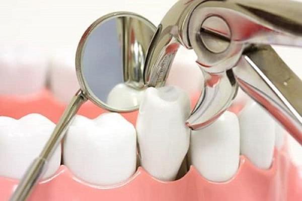 دندان عفونی و خطرات و عوارض کشیدن آن