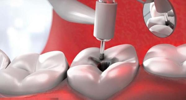برترین روش های پر کردن دندان با انواع مواد و مزایا و معایب آن ها