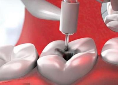 برترین روش های پر کردن دندان با انواع مواد و مزایا و معایب آن ها